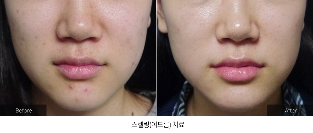 스켈링(여드름) 치료