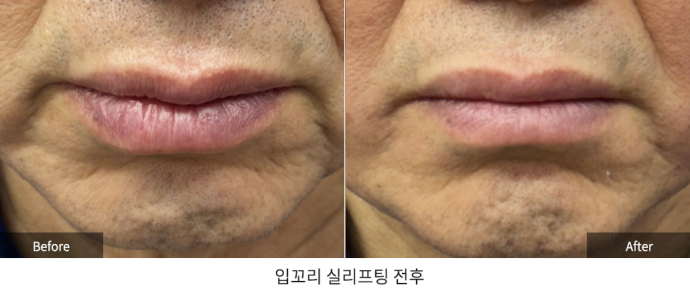 리프팅-입꼬리 실리프팅 시술